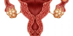 مضاعفات الحمل خارج الرحم